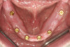 Fig 2. Locator implants were in the mandibular arch with stud-style (locator) abutments.