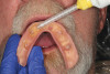 Fig 6. The mandibular prosthesis was air-dried, and light-body PVS was applied to its intaglio surface.