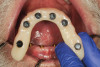 Fig 12. Processing housings were placed onto the abutments and the prosthesis was tried in. Composite resin was used to pick-up the housings.