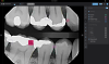 Fig 1. A bitewing radiograph displayed with clinical AI detections and bone level measurements. Caries detections (fuchsia) indicate depth of decay into various tooth structures. Calculus (green) and a notable margin (purple) are also highlighted in this example.