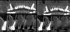 Fig 1. CBCT using the Feldkamp, Davis, and Kress (FDK) algorithm (left panel) and metal artifact reduction (MAR) algorithm (right panel). Note
the visible scatter and hardening associated with FDK is absent when MAR is used, and the bone quality is sharper and more defined with the
MAR image.