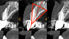 Fig 2. Triangle of bone. Outlining the available bone utilizing the
triangle of bone concept provides a design-making tree for the
clinician. Bisecting the triangle can aid in multiple aspects of
treatment planning, including implant positioning, selecting screwversus
cement-retained restorations, and grafting requirements,
among others.