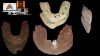 Fig 3. A 3D-printed model and surgical guide were fabricated using a resin printer (top left panel). Milled final zirconia abutment and
polymethyl methacrylate (PMMA) crown (bottom, top center, and right panels).