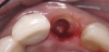 Fig 4. The palatal portion of the root was sectioned and
extracted. The remaining portion of the root must be trimmed to level of the alveolar crest and shaped to allow for implant placement. Roughly
1 to 2 mm of tooth thickness remains, with the length proportional to the extracted segment. No apical contents should remain, as apical
infection may occur. It is imperative to debride the apical root segment prior to implant placement.