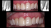 Fig 6. Immediate cemented
provisional crown. Note the lack of bleeding and healthy gingiva immediately postoperatively. Postoperative radiograph shows partial root,
implant, and zirconia abutment.