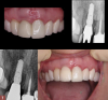 Fig 7. Top right panel: Postoperative radiograph at the 3 month
follow-up visit. Prefabricated coping was picked up and sent for
porcelain. Top left panel: Postoperative insertion photograph at the
3 month follow-up visit. Five-year follow-up periapical radiograph
(bottom left panel) and photograph (bottom right panel) reveal
healthy stable hard and soft tissue.