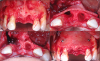 Fig 9. Stages of guided bone regeneration. Top left panel: Fullthickness
flap was elevated with vertical releasing incisions. Top
right panel: Laminar membrane was trimmed and seated. Bottom
left panel: Site debridement was performed and irrigated. Bottom
right panel: Tacks were placed to secure the membrane. Graft
material was condensed into the defect.