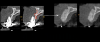 Fig 10. Preoperative versus postoperative CBCT. Cross-sectional comparison between the preoperative and postoperative conditions at
4.5 months postoperatively is shown. Note the large amount of graft volume obtained creating a proper site for implant placement.