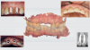 Fig 12. Tissue and scan bodies for implant IOS (top left, center, and bottom left
panels). Top right panel: Final screw-retained crowns were inserted. Note the healthy tissue. Bottom right panel: Radiograph taken 6 years
postoperatively shows excellent alveolar stability.