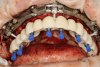 Fig 15. Provisional seated on the foundational stackable guide. Temporary cylinders were inserted on top of multi-unit abutments.