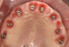 Fig 17. Soft tissue development from partial extraction therapy, bone sculpting, and provisional appliance. At this stage the tissue was ready
for impressions.