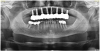 Fig 20. Final monolithic zirconia prosthetic at 3 years postoperatively. Note stable hard/soft tissue
response and lack of inflammation.