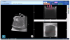 Fig 2. With the use of a dual-cure bulkfill
composite, 100% adaptation to the
cavity floor and no gap formation in
a high C-Factor preparation are demonstrated.