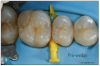 Fig 5. Preoperative wedging to create tight
contacts. (Photograph courtesy of Richard
Young, DDS.)