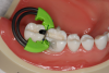 Fig 7. Tack welding matrix on buccal and lingual with flowable to ensure tight contact.