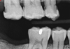 Fig 8. A 77-yearold
male patient presented with a distal lesion on tooth No. 2, previously treated with restorations that had failed.
