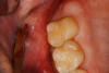 Fig 9. View of existing occlusal composite to be removed to access the distal lesion on tooth No. 2.