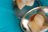 Fig 11. Final preparation after gingitage with coarse diamond bur to remove soft tissue from the cavity in tooth No. 2.