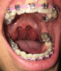 Fig 2. Example of enlarged tonsils. (Photograph credit: Timothy D. Frantz, MD, ENT)