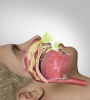 Fig 3. OSA is often the result of the mandible and tongue falling posteriorly.