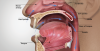 Fig 1. Four points of obstruction to proper sleep breathing: 1, nasal valve; 2, nasal pharynx; 3, velopharynx; 4, oropharynx. Nasal dilators are an important component of OSA therapy, as nasal valve dilation decreases intraluminal pressures in the oropharynx, reducing apneic events. The velopharynx is the narrowest portion of the airway; its frequency in OSA is 81%. The oropharynx and the base of the tongue have frequencies in OSA of 21.9% and 46.6%, respectively.