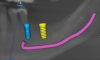 Fig 1. Implant planning and mandibular canal indicated in CBCT.