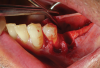 Fig 3. Premolar extracted and flap release.