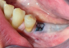 Fig 6. Clinical observation at re-entry (5.5 months after grafting) showing exposure of the mesh.