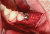 Fig 8. Healing abutment placed on the implant.