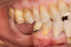 Fig 11. Intraoral condition showing severe atrophy of the right side of the mandible.