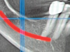 Fig 12. Radiograph and drawing of the mandibular canal.