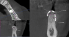 Fig 22. CBCT showing different gains of bone width before mesh removal, Patient 1.