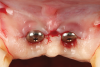 Fig 3. Coronally advanced flap after removal of the crowns for soft-tissue augmentation.
