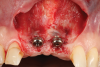 Fig 4. Split-thickness flap elevation.