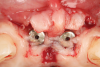 Fig 10. Flap elevation. Note that the mid portion of the flap was de-epithelialized to be rolled between the two implants.