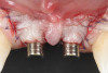 Fig 12. Abutment connection and flap suturing.