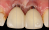 Fig 15. Clinical comparison of the volumetric gain obtained with the intervention, frontal views. Fig 15: Frontal view at baseline. Fig 16: Frontal view at 1-year post-treatment.