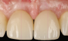 Fig 16. Clinical comparison of the volumetric gain obtained with the intervention, frontal views. Fig 15: Frontal view at baseline. Fig 16: Frontal view at 1-year post-treatment.