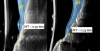 Fig 19. Ultrasonographic comparison of the volumetric gain obtained with the intervention. Fig 19: Baseline. Fig 20: 1-year post-treatment. “C” identifies the crown, “A” the abutment, “I” the implant fixture, and “ST” the soft tissue. The soft tissue at baseline (Fig 19) is highlighted in blue, while the soft tissue at the 1-year follow-up (Fig 20) is shown in purple. Mucosal thickness (“MT”) at baseline (Fig 19) and at 1 year (Fig 20) is also displayed. (In both figures, the left panel is implant No. 8 midfacial, and the right panel is implant No. 9 midfacial.)