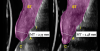 Fig 20. Ultrasonographic comparison of the volumetric gain obtained with the intervention. Fig 19: Baseline. Fig 20: 1-year post-treatment. “C” identifies the crown, “A” the abutment, “I” the implant fixture, and “ST” the soft tissue. The soft tissue at baseline (Fig 19) is highlighted in blue, while the soft tissue at the 1-year follow-up (Fig 20) is shown in purple. Mucosal thickness (“MT”) at baseline (Fig 19) and at 1 year (Fig 20) is also displayed. (In both figures, the left panel is implant No. 8 midfacial, and the right panel is implant No. 9 midfacial.)