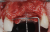 Fig 3. Horizontal and vertical bone defect after flap reflection.