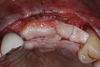 Fig 11. Soft-tissue augmentation with two CTGs.