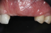 Fig 13. Distortion of the mucogingival junction.