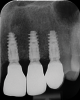 Fig 17. Final radiographic outcome at 12 months post–iCTG augmentation.