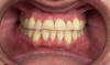 Fig 1. Severe attrition of teeth Nos. 5 through 12.