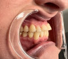 Fig 2. Right lateral view, showing severe attrition of teeth Nos. 5 though 12, abfraction lesions on teeth Nos. 6 and 11, 
and overjet.