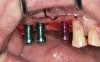 Fig 11. Dental implants are inserted through the crestal osteotomy preparation;