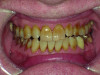 Close-up view of patient’s dentition in 2017 showing increased facial and buccal erosion over the past 8 years.