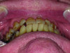 Uncentered midline and tooth rotations of teeth Nos. 7 and 10.