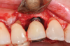 Fig 3. A narrow three-wall infrabony defect was visualized on the facial of the implant.